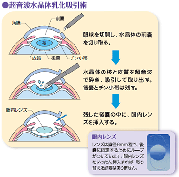 CXgŌ锒p